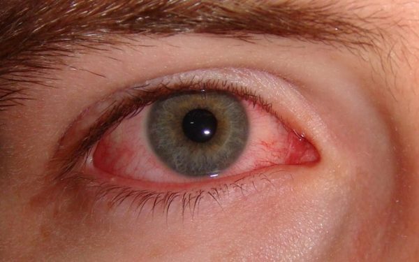 Đau mắt đỏ lây qua đường nào và cách phòng tránh lây lan mà bạn cần biết