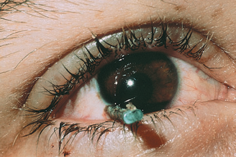 Chấn thương mắt là gì?