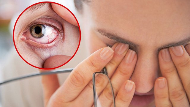 Nguyên nhân nào dẫn đến tình trạng bị khô mắt?